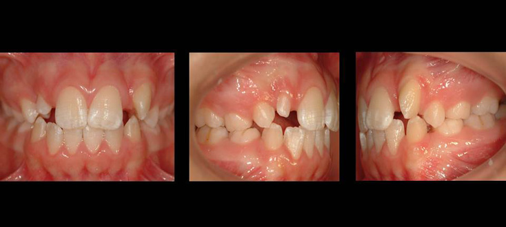 Caso inicial: ausências dentárias