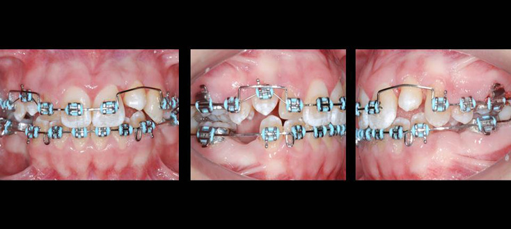 Tratamento: pré-molar transplantado para espaço do incisivo lateral superior esquerdo