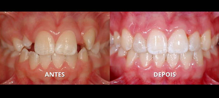 Ausência dentária tratada com autotransplante