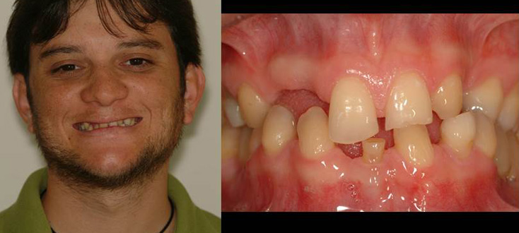 Paciente com ausências dentárias, desgaste dos dentes anteriores e dimensão vertical reduzida