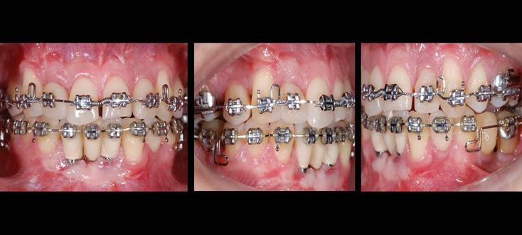 Durante o tratamento, implantes posicionados nos espaços definidos pela ortodontia