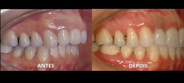 Correção: ortodontia com cirurgia combinada