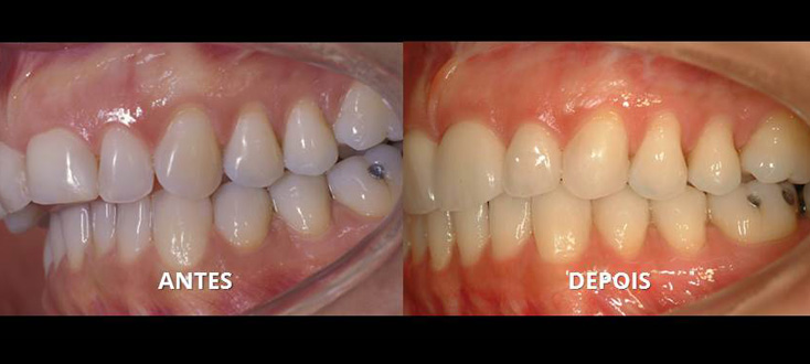 Correção: ortodontia com cirurgia combinada