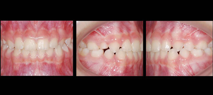 Oclusão normal na dentição mista