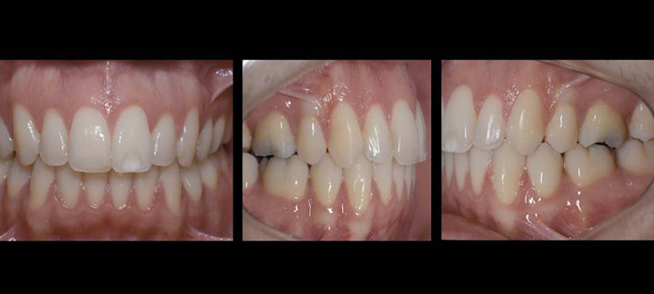 Caso final: oclusão normal após ortodontia