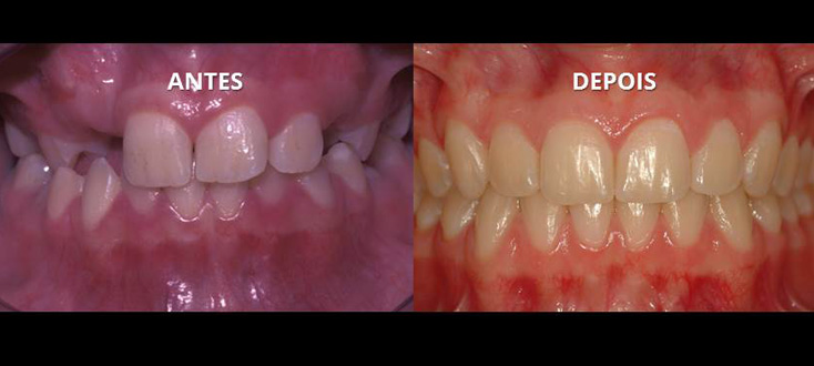 Correção de caso com dentes impactados