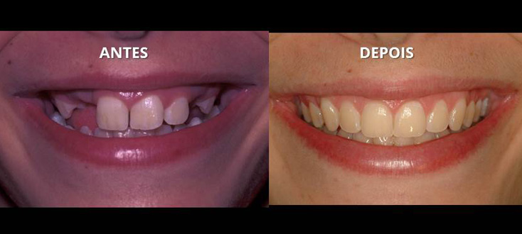 Correção de caso com dentes impactados