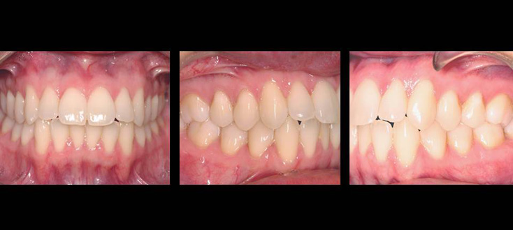 Caso inicial: biprotusão dentária