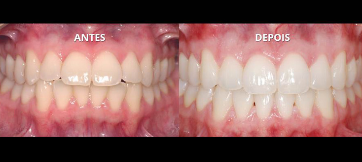 Desgastes interdentais para biprotusão dentária