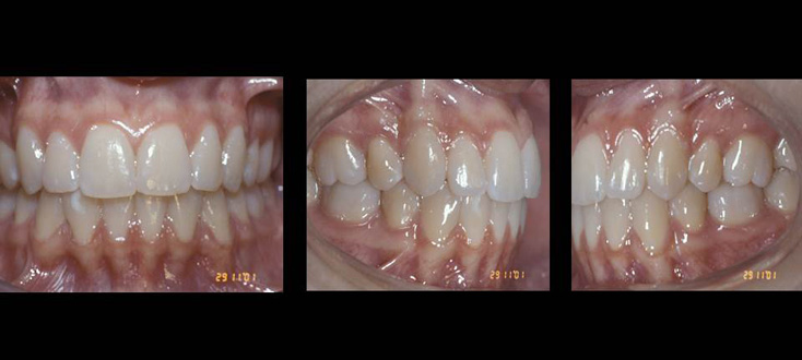 Caso final: oclusão normal sem primeiros pré-molares