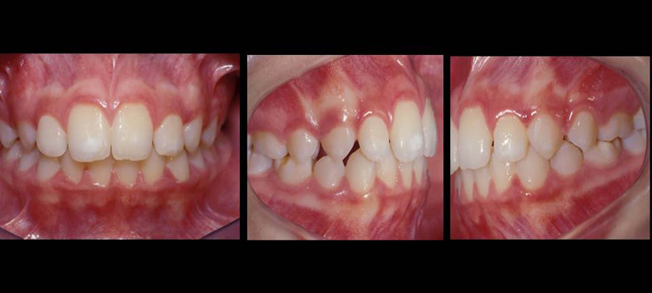Caso final: oclusão normal na dentição mista